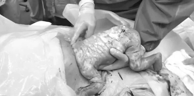 Kepala Bayi Copot Tertinggal di Dalam Rahim, Sang Ibu Gagal Melahirkan Sungsang