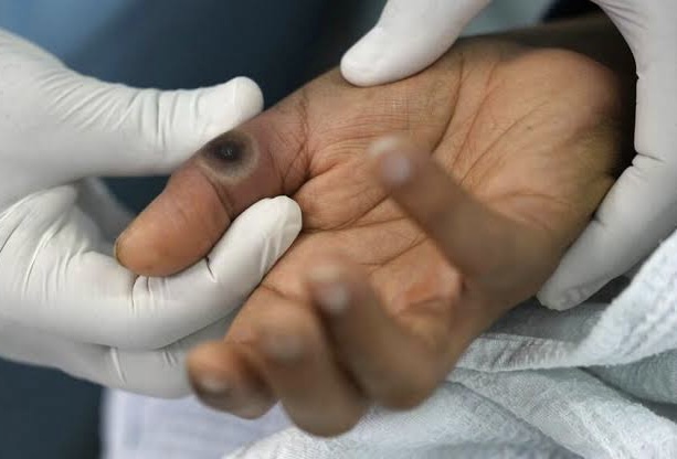 Wow! Tiap Bulan Kasus HIV di Indonesia Bertambah 4 Ribu Pasien Baru, Dominasi Ibu Rumah Tangga