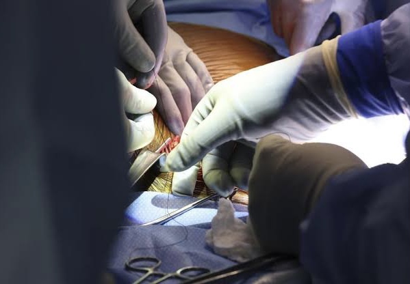 Sempat Bertahan Hidup, Pasien Transplantasi Ginjal Babi Pertama di Dunia Akhirnya Meninggal