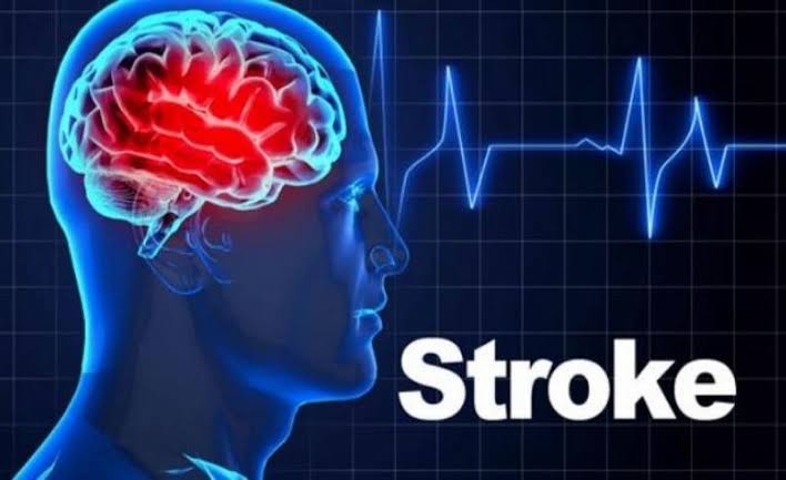 Inilah 3 Pemicu Stroke Menyerang Anak Muda