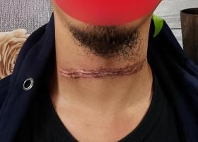 Kabel Internet Diduga Ilegal Kembali Makan Korban di Kepulauan Meranti, Warga Terluka di Leher